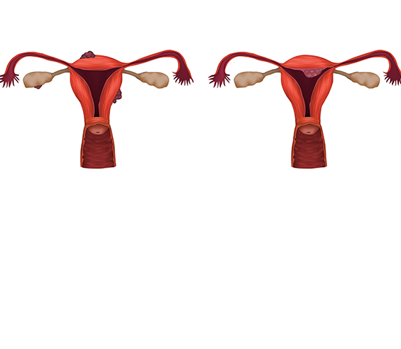 Endometrioma ve MYOM Operasyonu